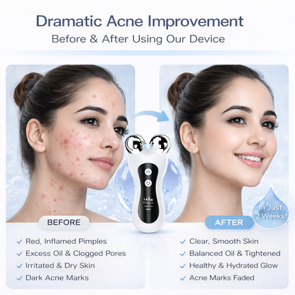 Lyvon™ Skin Acne Device